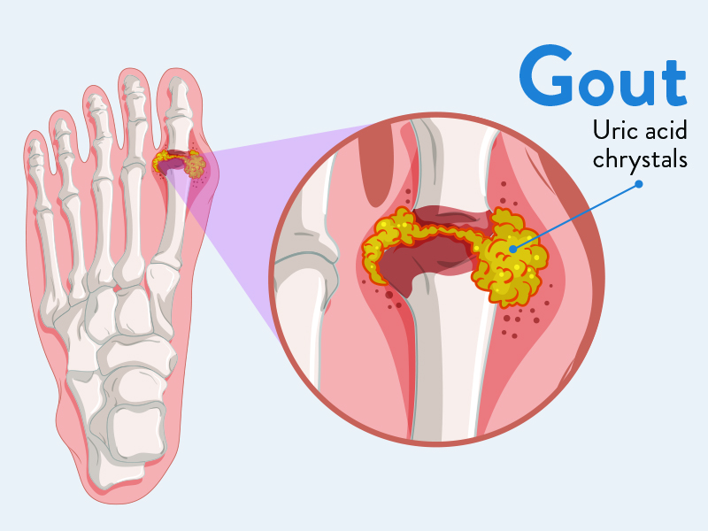 Laser Therapy for Pain